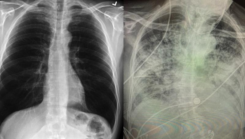 Después de la COVID-19, pulmones podrían quedar más dañados que los de los fumadores